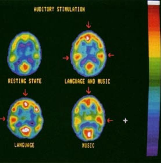 Cette image est une scanographie PET du cerveau, elle montre que le langage est principalement traité dans l’hémisphère gauche du cerveau et la musique dans l’hémisphère droit.